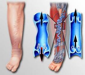 Circolazione sanguigna nella gamba con vene varicose