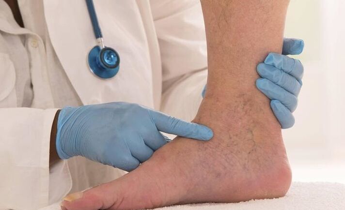 il medico esamina la gamba con le vene varicose