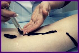La procedura per il trattamento delle vene varicose con le sanguisughe (hirutherapy)