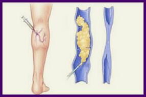 La scleroterapia è un modo popolare per sbarazzarsi delle vene varicose sulle gambe
