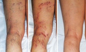 Sintomi delle vene varicose nelle gambe