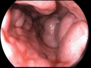 varici dell'esofago