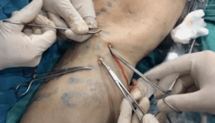 Come viene eseguita una flebetomia per rimuovere le vene varicose